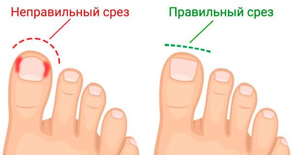 Вросший ноготь - лечение Вросший ноготь - лечение