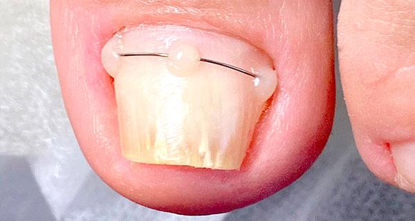 Лечение вросшего ногтя - титановая нить Лечение вросшего ногтя - титановая нить