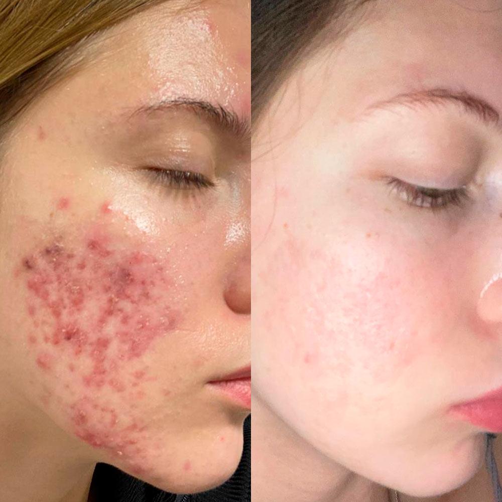 Лечение акне у дерматолога - результат До/После