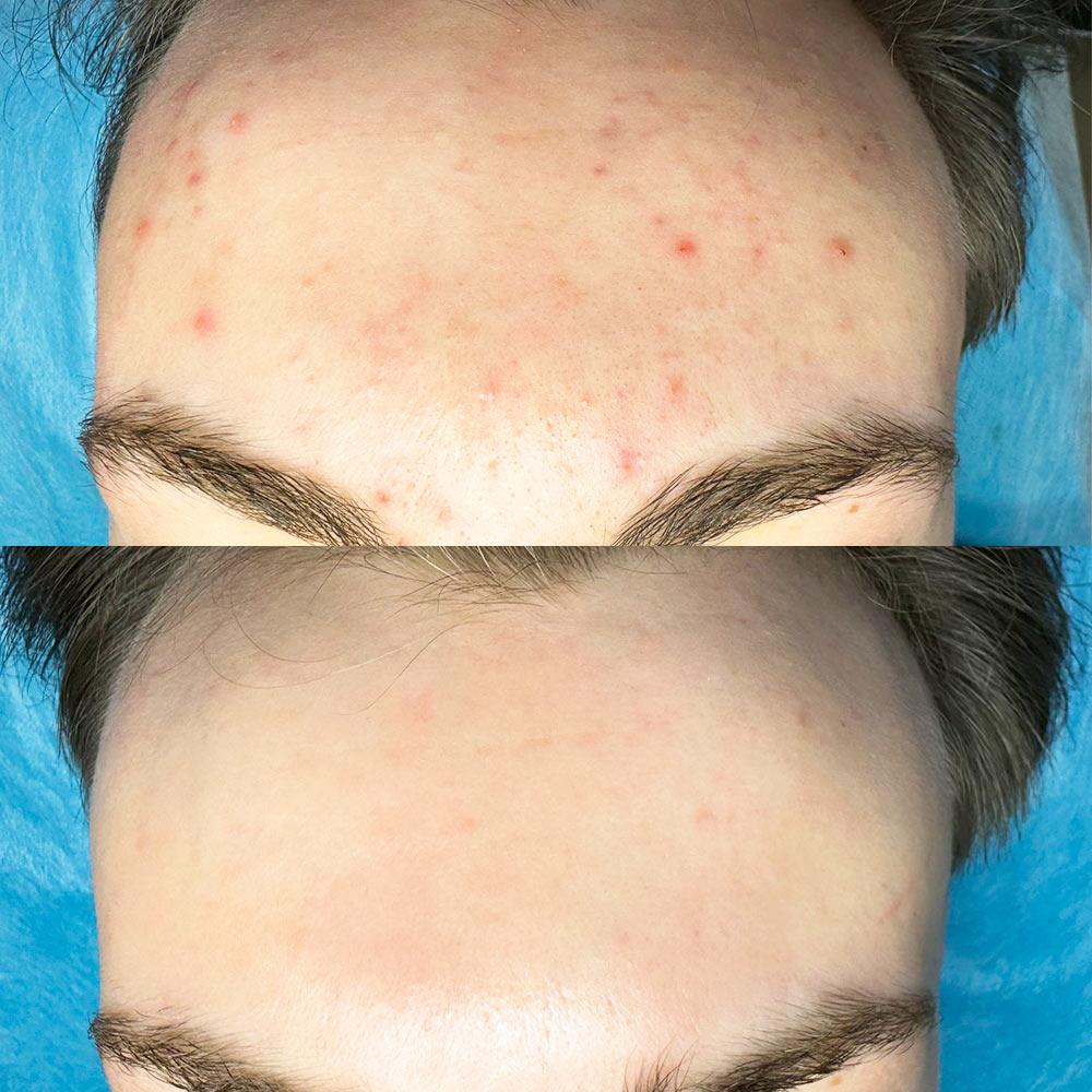 Акне - результат лечения в SENSAVI Киев