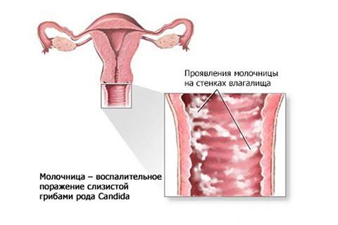 Молочница - вульвовагинальный кандидоз Молочница - вульвовагинальный кандидоз