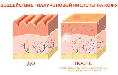 Биоревитализация кожи лица Киев Биоревитализация кожи лица Киев
