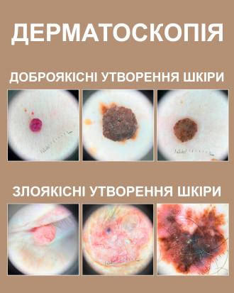 Дерматоскопия родинок Киев Дерматоскопия родинок Киев