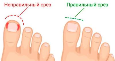 Вросший ноготь - лечение 